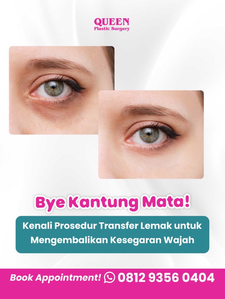 Bye Kantung Mata! Kenali Prosedur Transfer Lemak di Bawah Mata untuk Mengembalikan Kesegaran Wajah