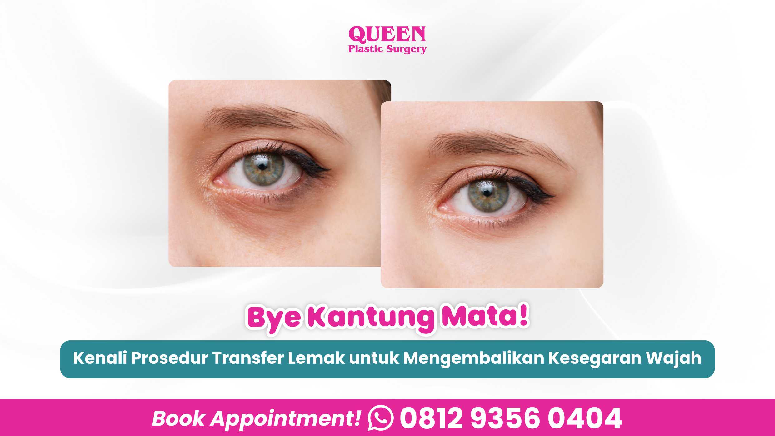 Bye Kantung Mata! Kenali Prosedur Transfer Lemak di Bawah Mata untuk Mengembalikan Kesegaran Wajah