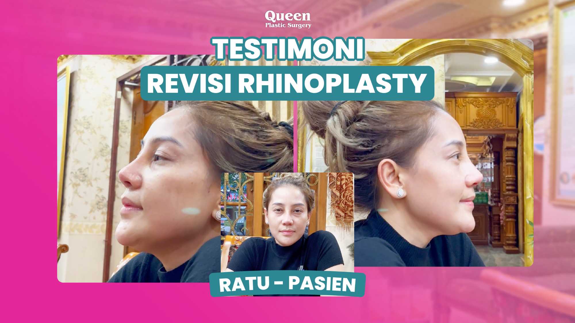 Tingkat Keberhasilan Revisi Rhinoplasty: Bisakah Hidung Kembali Sempurna? Cek Faktanya!