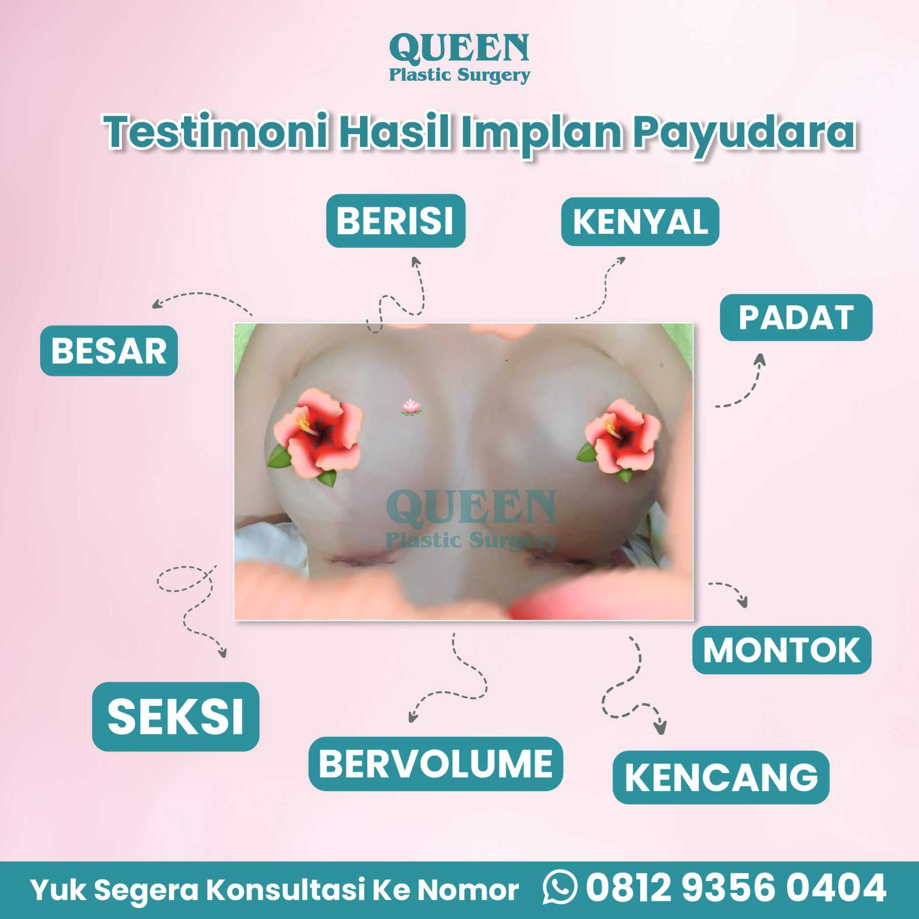 Implan vs Pembesaran Payudara: Apa Bedanya? Cari Tahu di Sini!