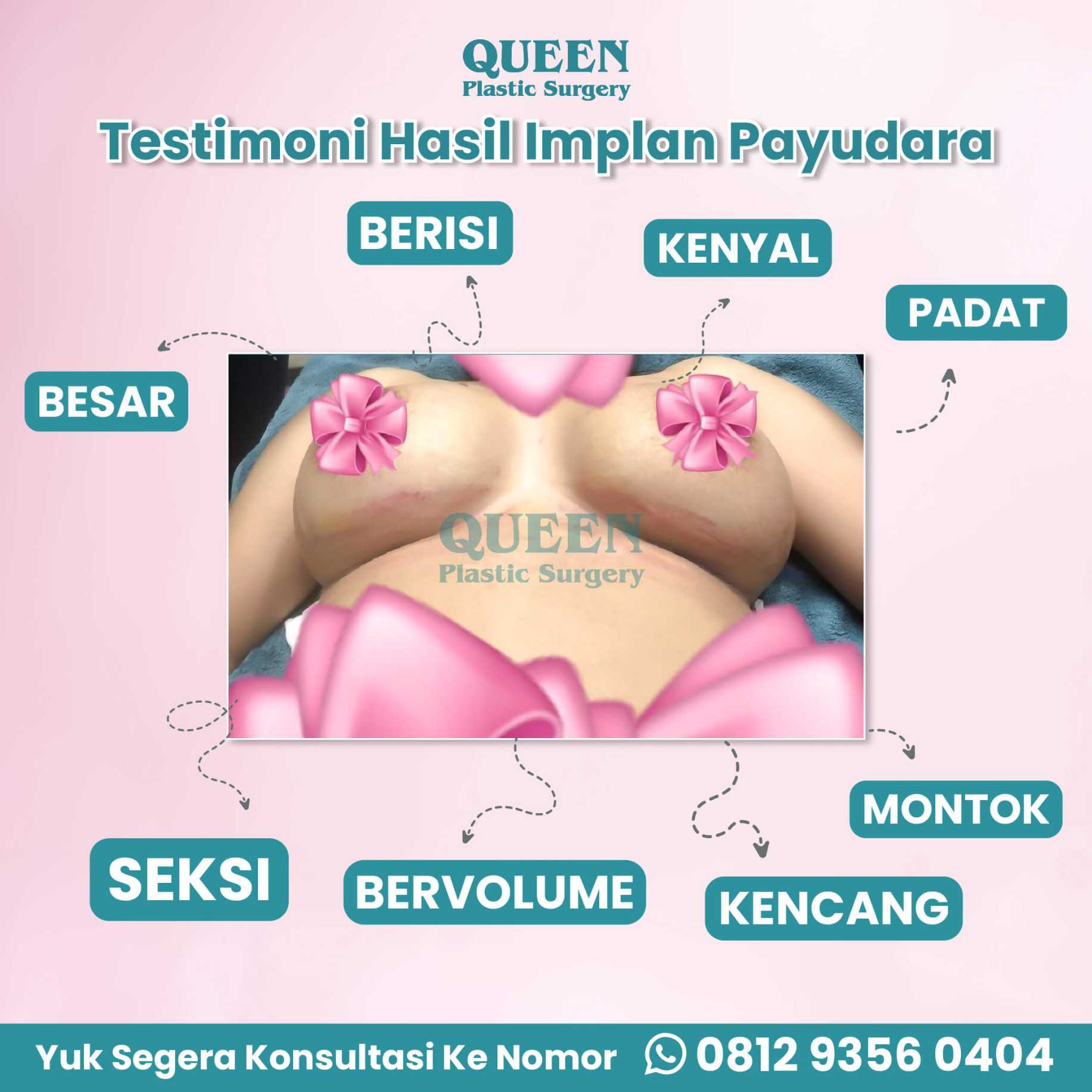 Implan vs Pembesaran Payudara: Apa Bedanya? Cari Tahu di Sini!