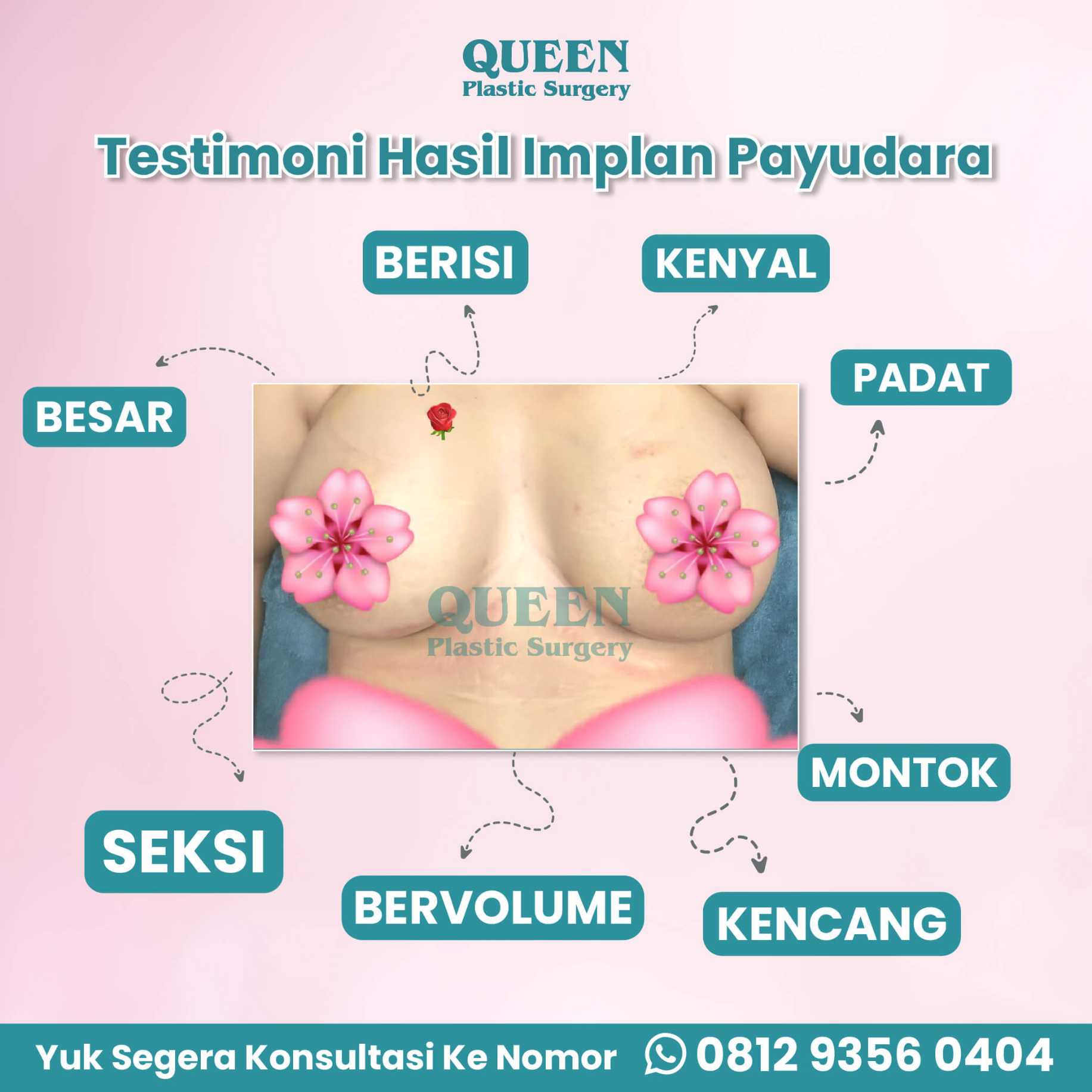 Implan vs Pembesaran Payudara: Apa Bedanya? Cari Tahu di Sini!