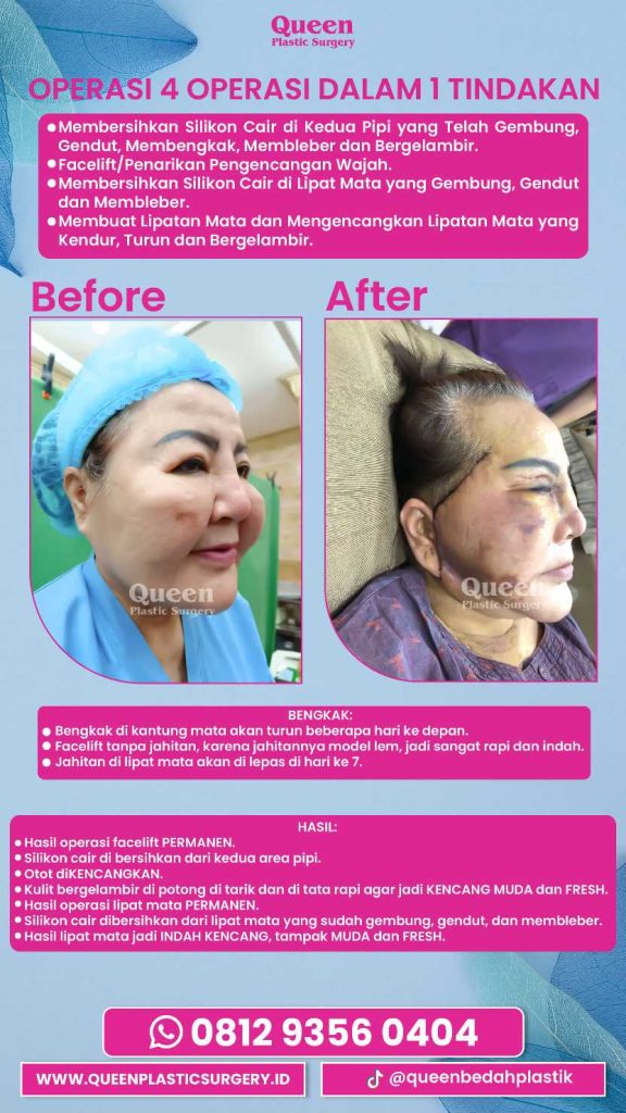 Berapa Kali Facelift Bisa Dilakukan? Ini Batas Amannya! Cek di Sini!