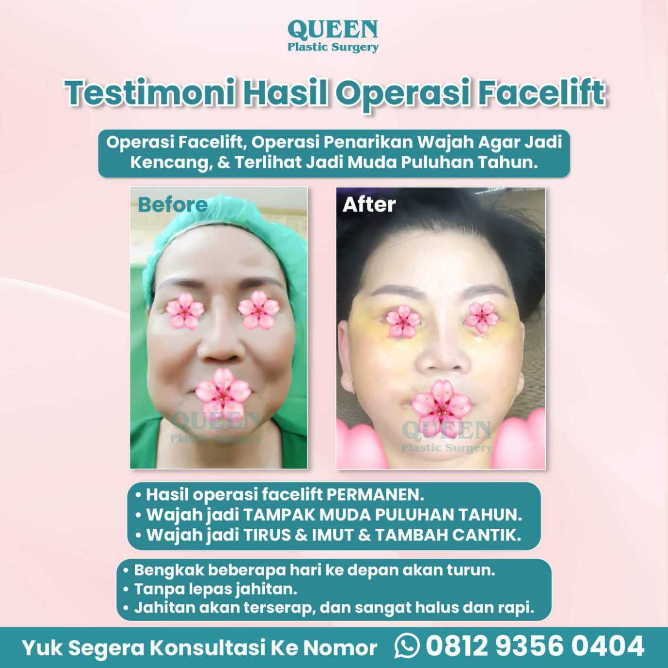Tampil 10 Tahun Lebih Muda dengan Facelift dan Pengencangan Alis (Alis Mata)