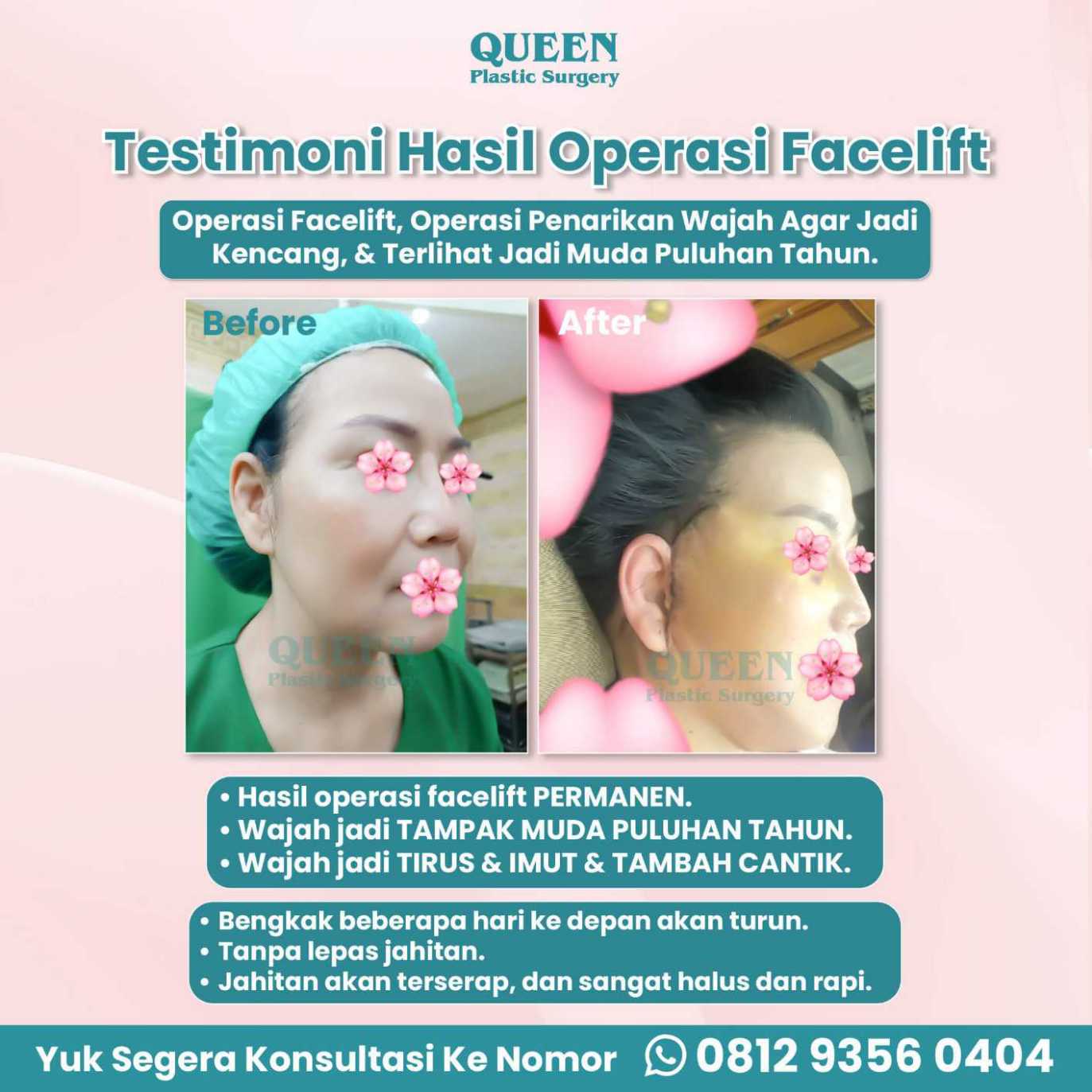 Tampil 10 Tahun Lebih Muda dengan Facelift dan Pengencangan Alis (Alis Mata)