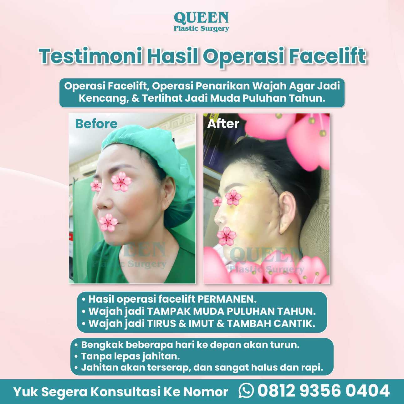 Tampil 10 Tahun Lebih Muda dengan Facelift dan Pengencangan Alis (Alis Mata)
