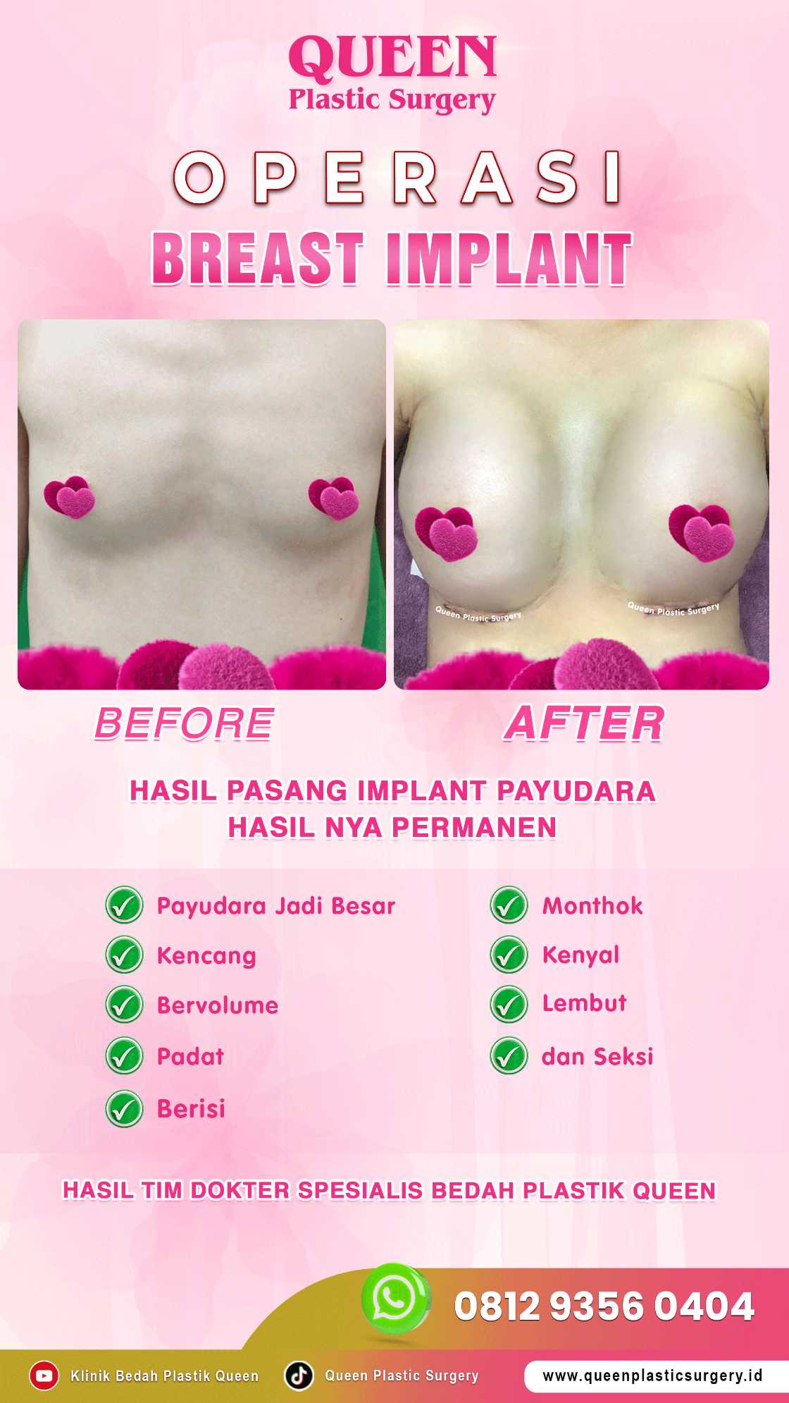 Kapan Usia Terbaik untuk Operasi Pengencangan Payudara? Cek Faktanya!