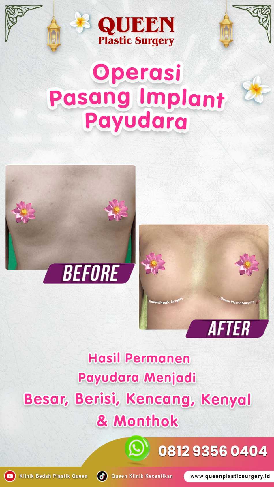 Ingin Bentuk Ideal? Pahami Perbedaan Pengencangan dan Pengecilan Payudara