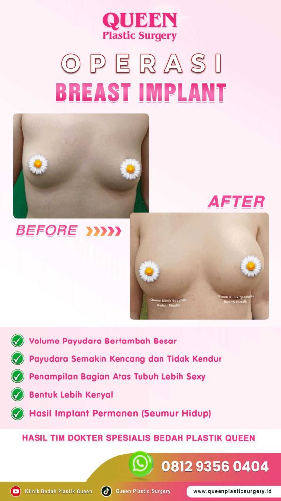 Fakta Mengapa Implan Payudara Modern Terbukti Aman. Baca Selengkapnya!