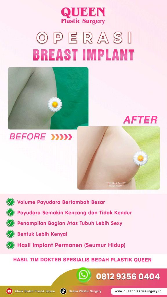 Fakta Mengapa Implan Payudara Modern Terbukti Aman. Baca Selengkapnya!