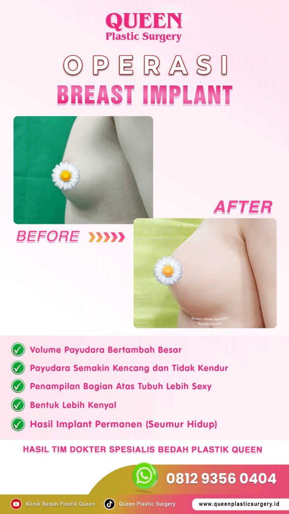 Fakta Mengapa Implan Payudara Modern Terbukti Aman. Baca Selengkapnya!