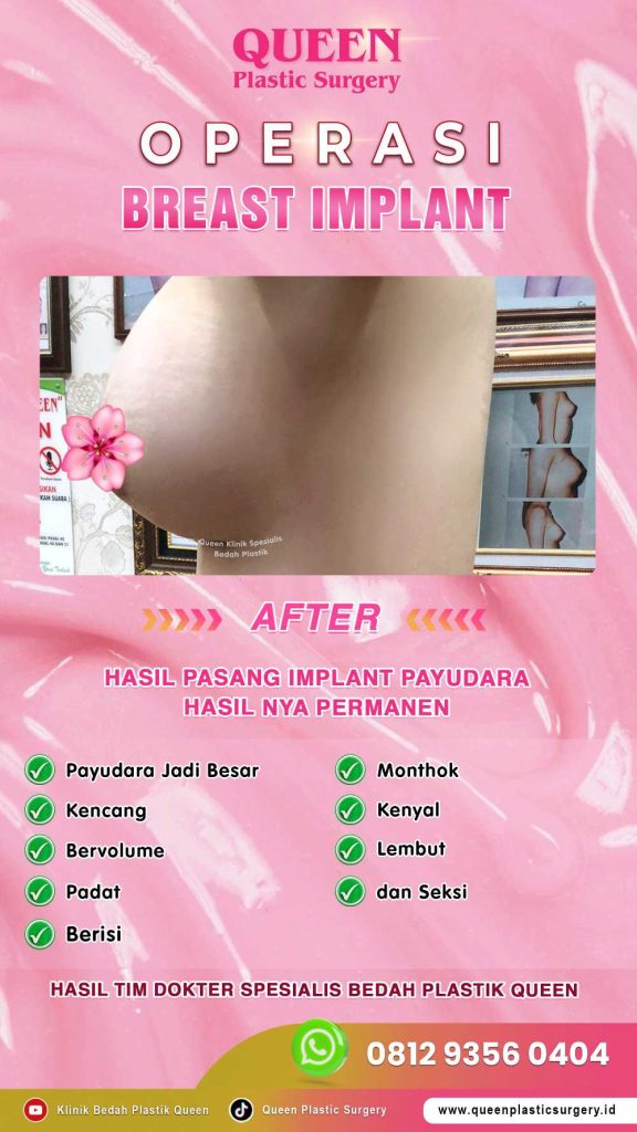 Ingin Bentuk Ideal? Pahami Perbedaan Pengencangan dan Pengecilan Payudara