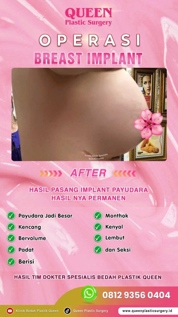 Fakta Mengapa Implan Payudara Modern Terbukti Aman. Baca Selengkapnya!