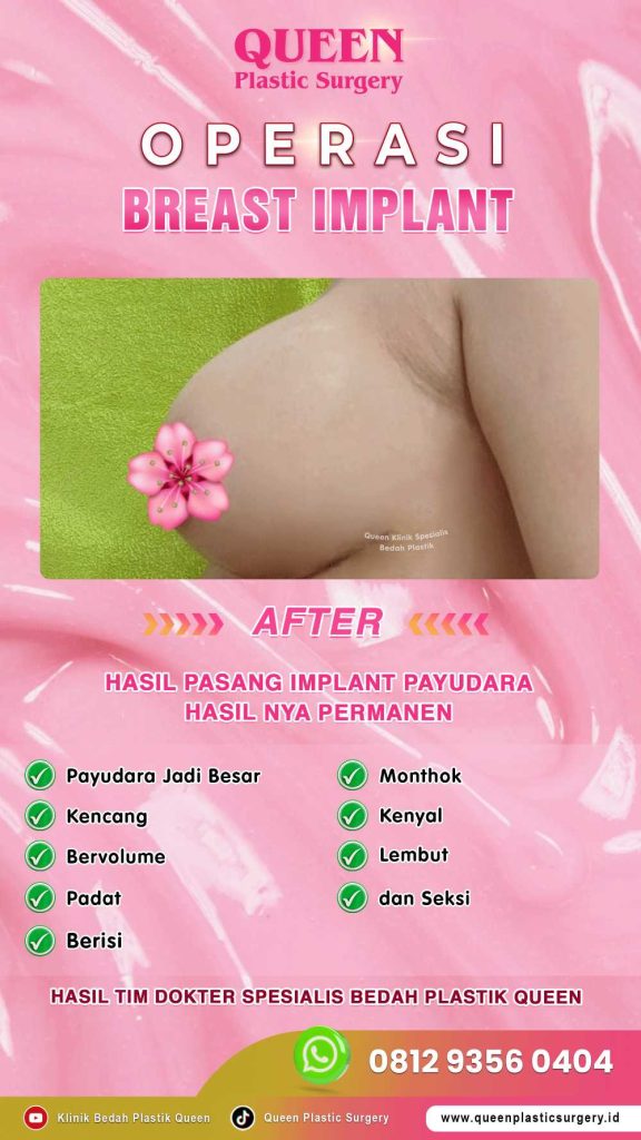 Ingin Bentuk Ideal? Pahami Perbedaan Pengencangan dan Pengecilan Payudara