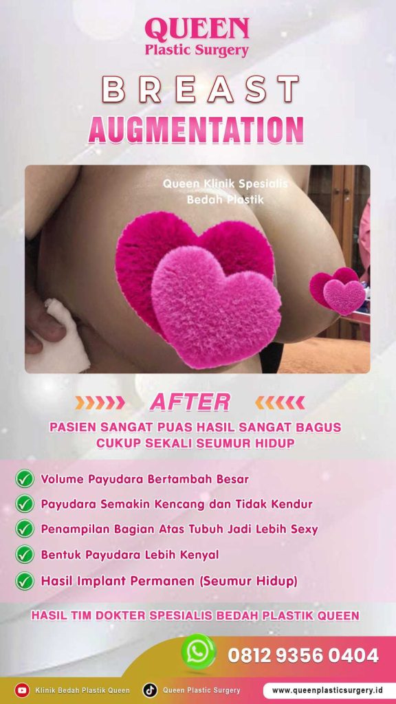 Bisakah Transfer Lemak Menggantikan Implan? Temukan Jawabannya!