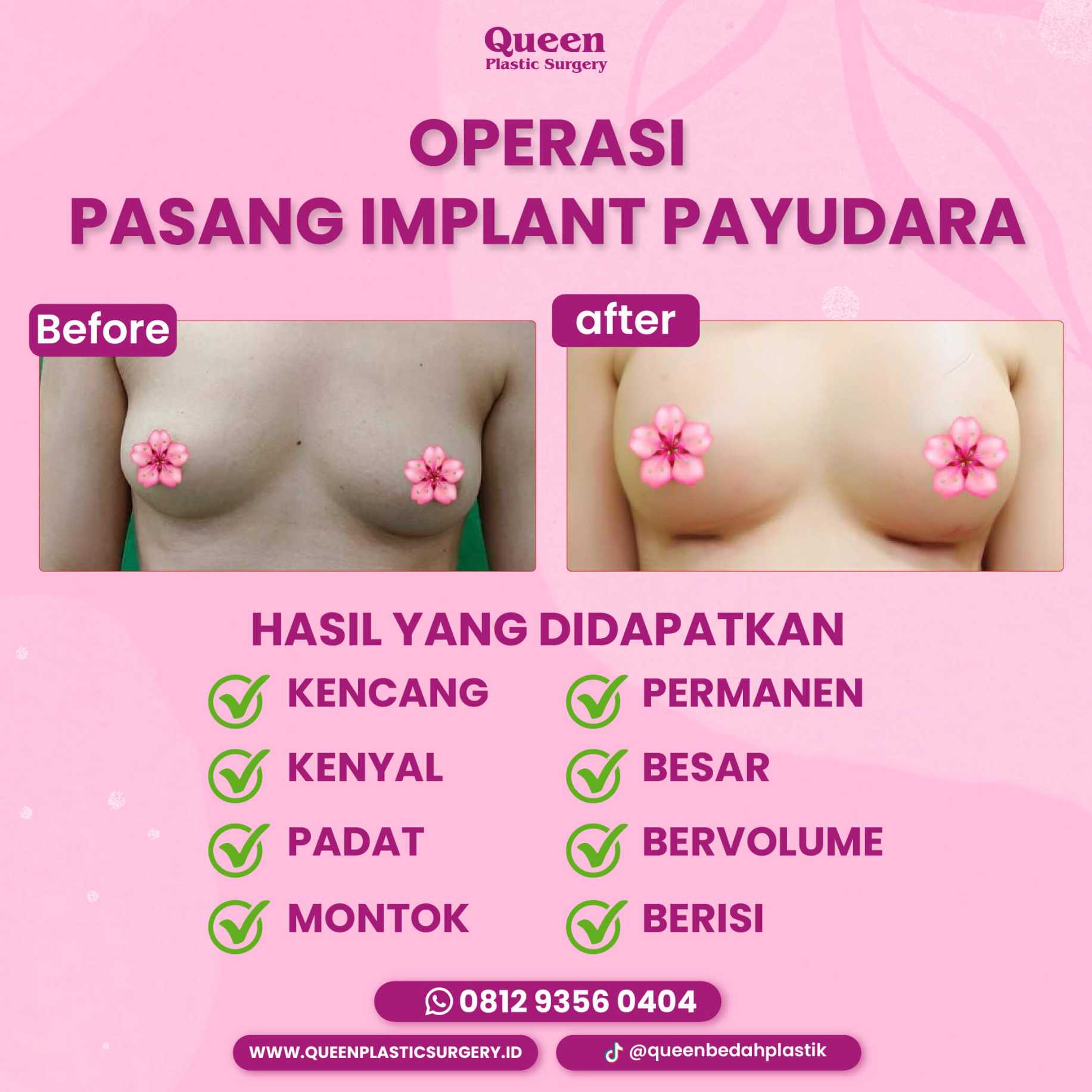 Aturan Mengemudi Pasca Bedah Payudara agar Pemulihan Maksimal
