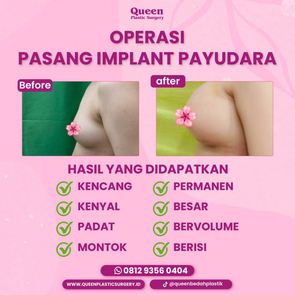 Aturan Mengemudi Setelah Operasi Pengencangan Payudara agar Pemulihan Maksimal