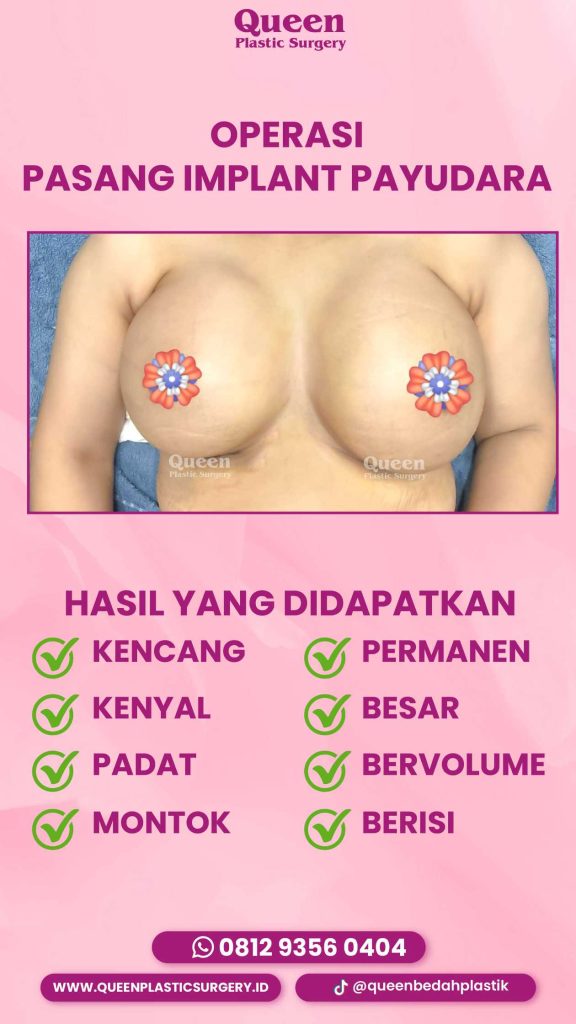 Bisakah Transfer Lemak Menggantikan Implan? Temukan Jawabannya!