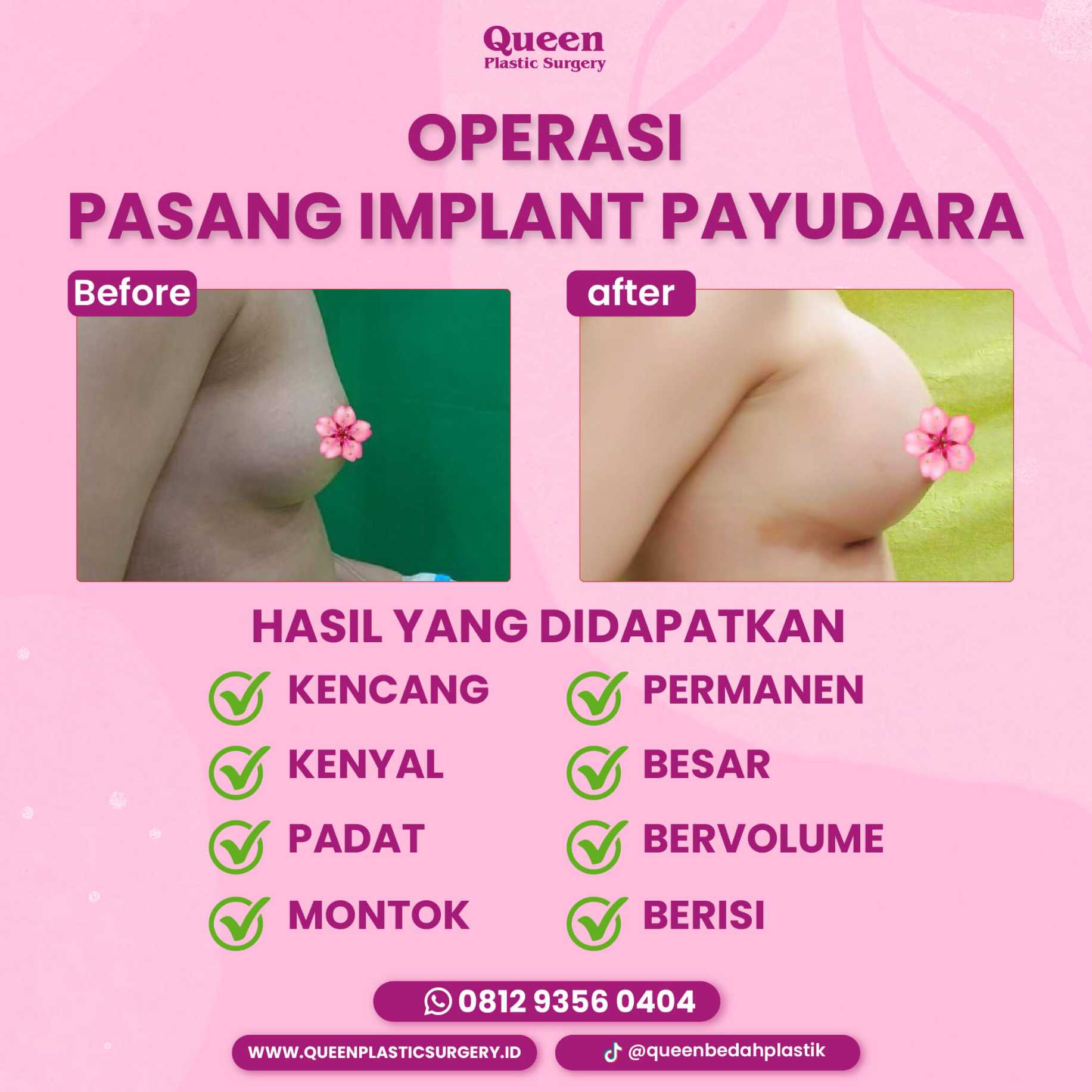 Aturan Mengemudi Pasca Bedah Payudara agar Pemulihan Maksimal