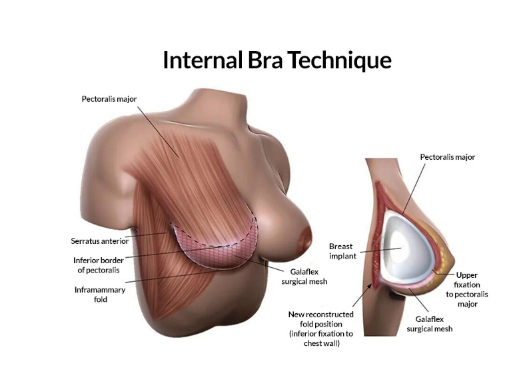 Stop Kendur! Teknik "Bra Internal" Revolusi Operasi Payudara, Wujudkan Hasil Maksimal! 