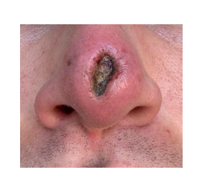 Penting! Memahami Tanda-Tanda Nekrosis Setelah Rhinoplasty Yang Wajib Diketahui