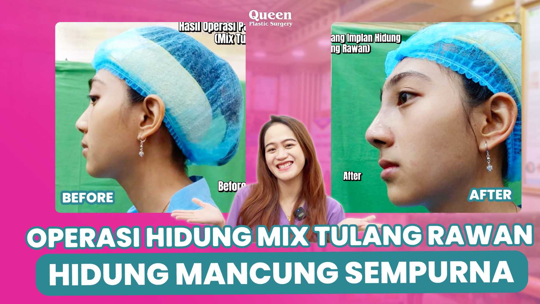Mengenal Rhinoplasty Tulang Rusuk (Autologous Rib Cartilage), Pahami Prosedurnya!
