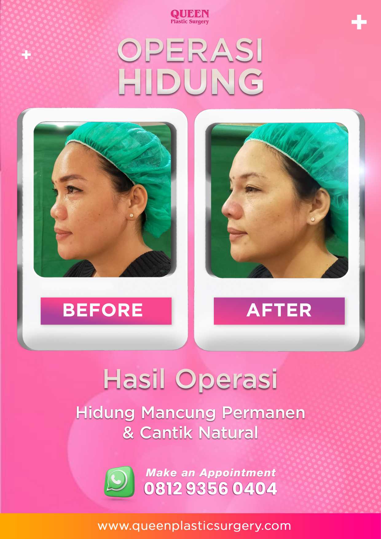Kapan Hidung Kembali Normal Pasca Rhinoplasty? Yuk, Cari Tahu Prosesnya!