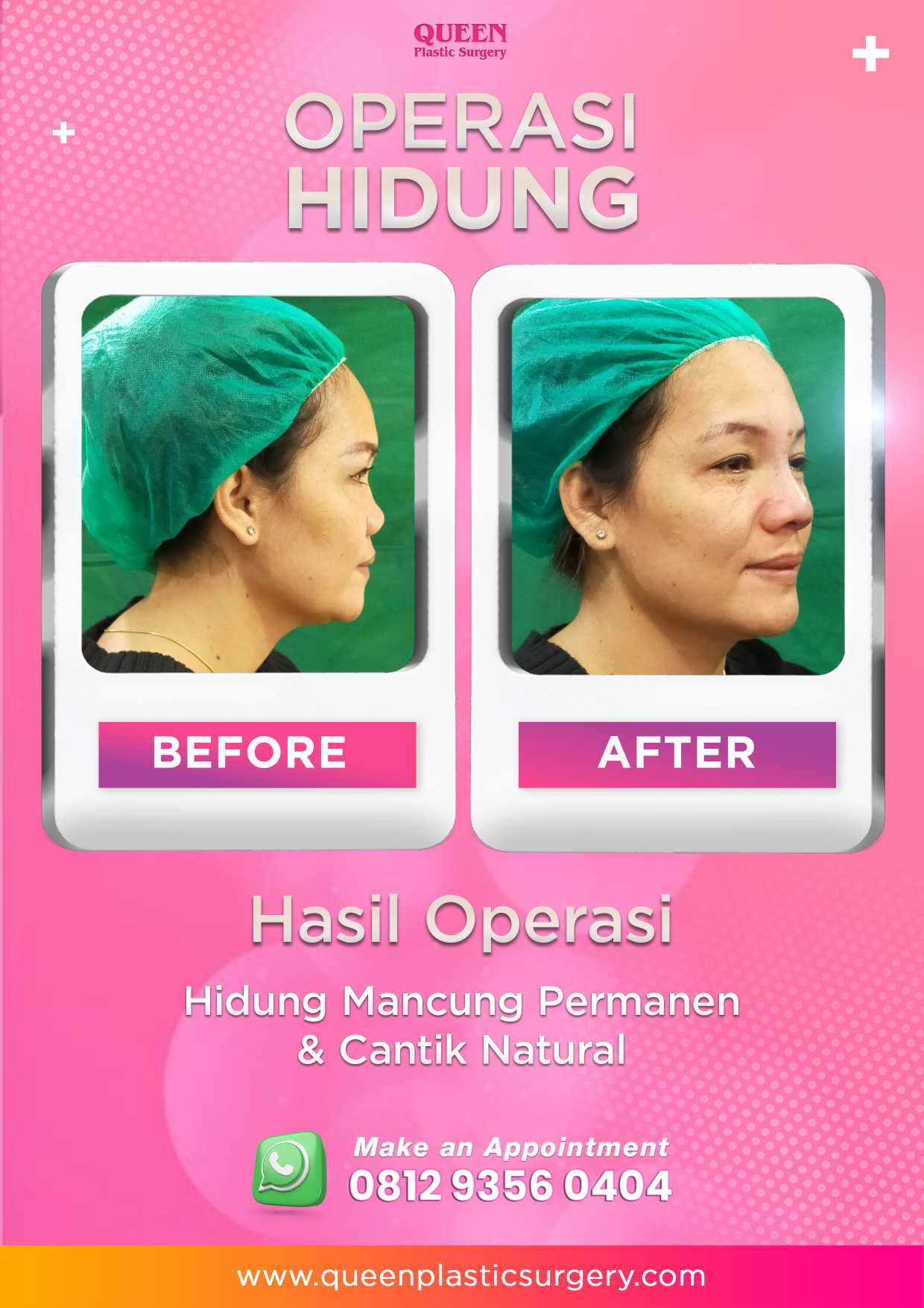 Kapan Hidung Kembali Normal Pasca Rhinoplasty? Yuk, Cari Tahu Prosesnya!