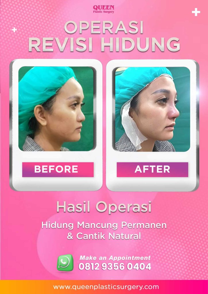 Penting! Memahami Tanda-Tanda Nekrosis Setelah Rhinoplasty Yang Wajib Diketahui