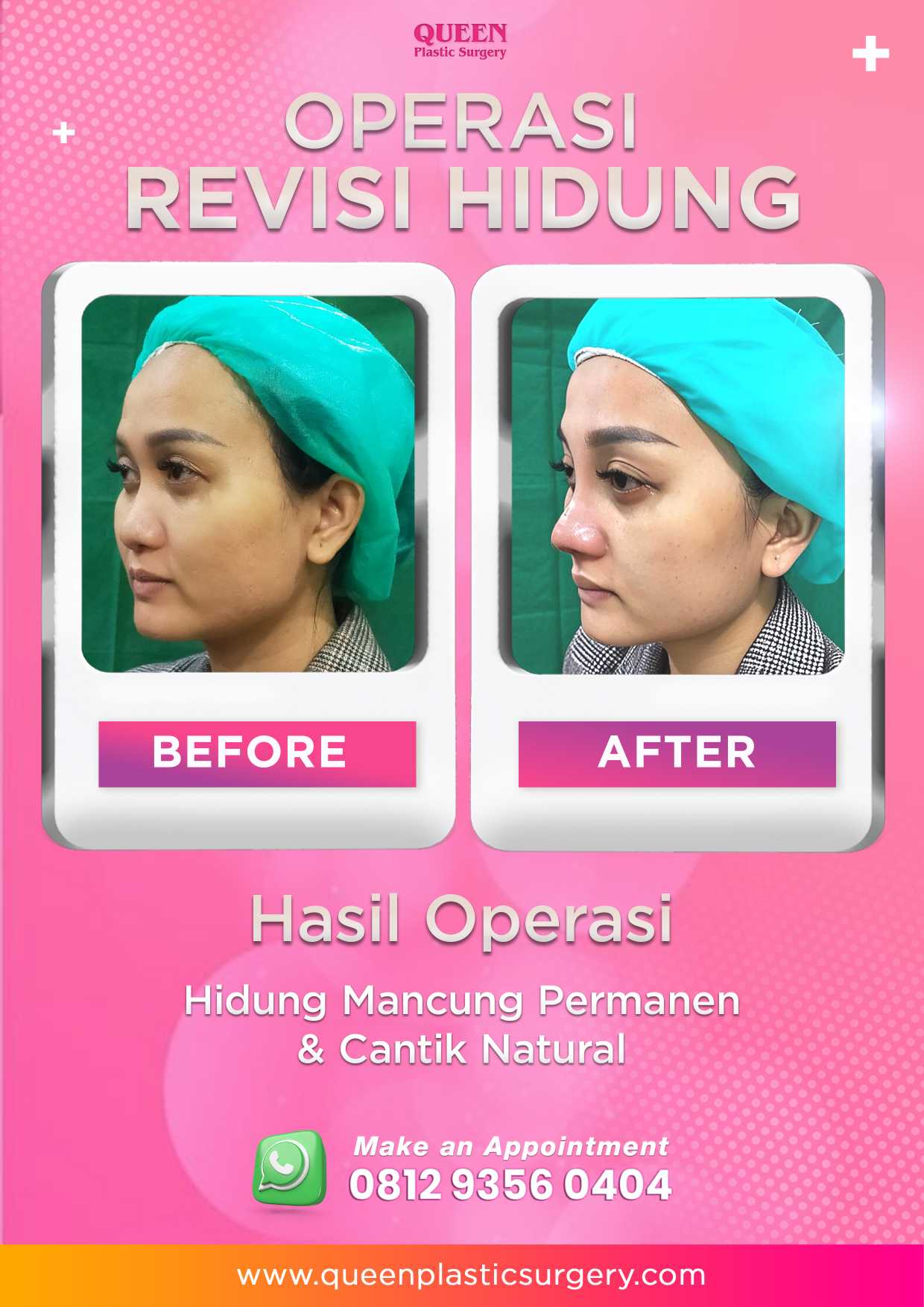 Penting! Memahami Tanda-Tanda Nekrosis Setelah Rhinoplasty Yang Wajib Diketahui
