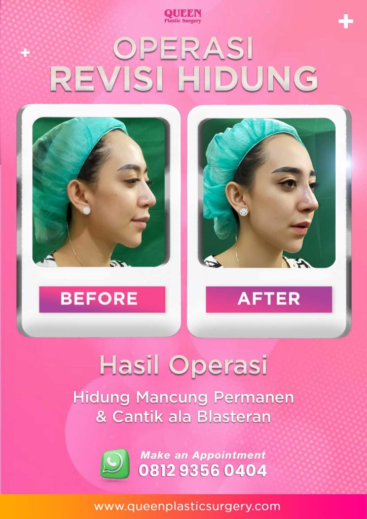Gagal Operasi Hidung? Ini Tanda Operasi Hidung Yang Buruk