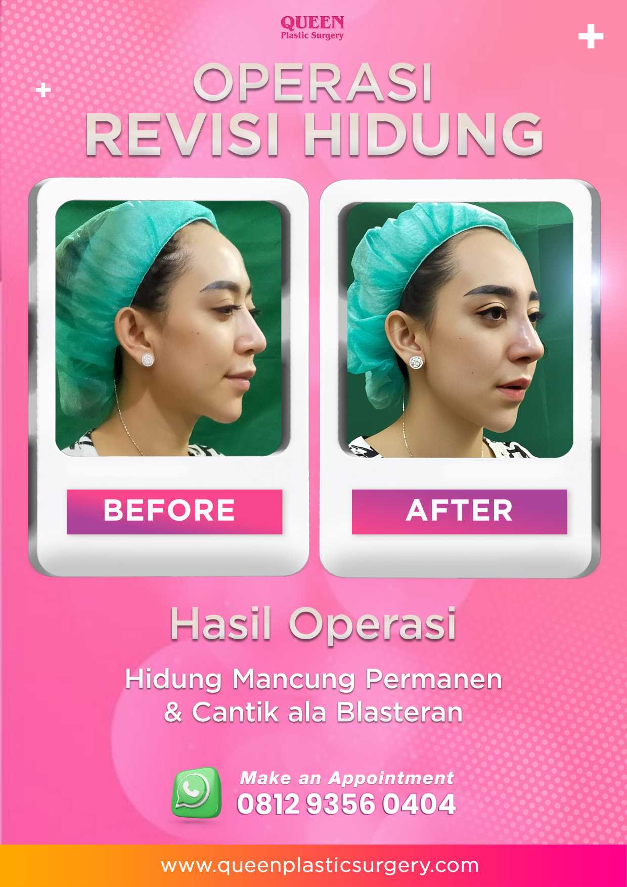 Gagal Operasi Hidung? Ini Tanda Rhinoplasty Tidak Berhasil