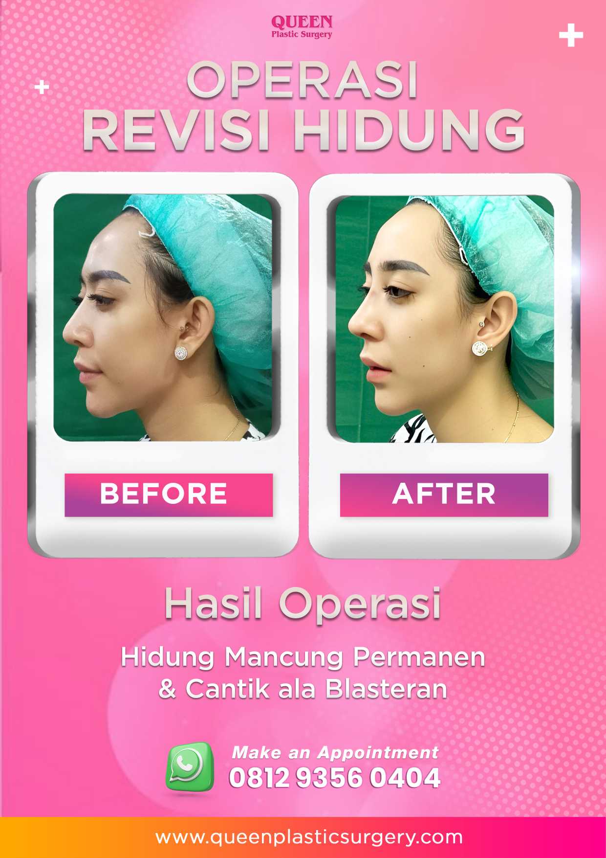 Gagal Operasi Hidung? Ini Tanda Rhinoplasty Tidak Berhasil