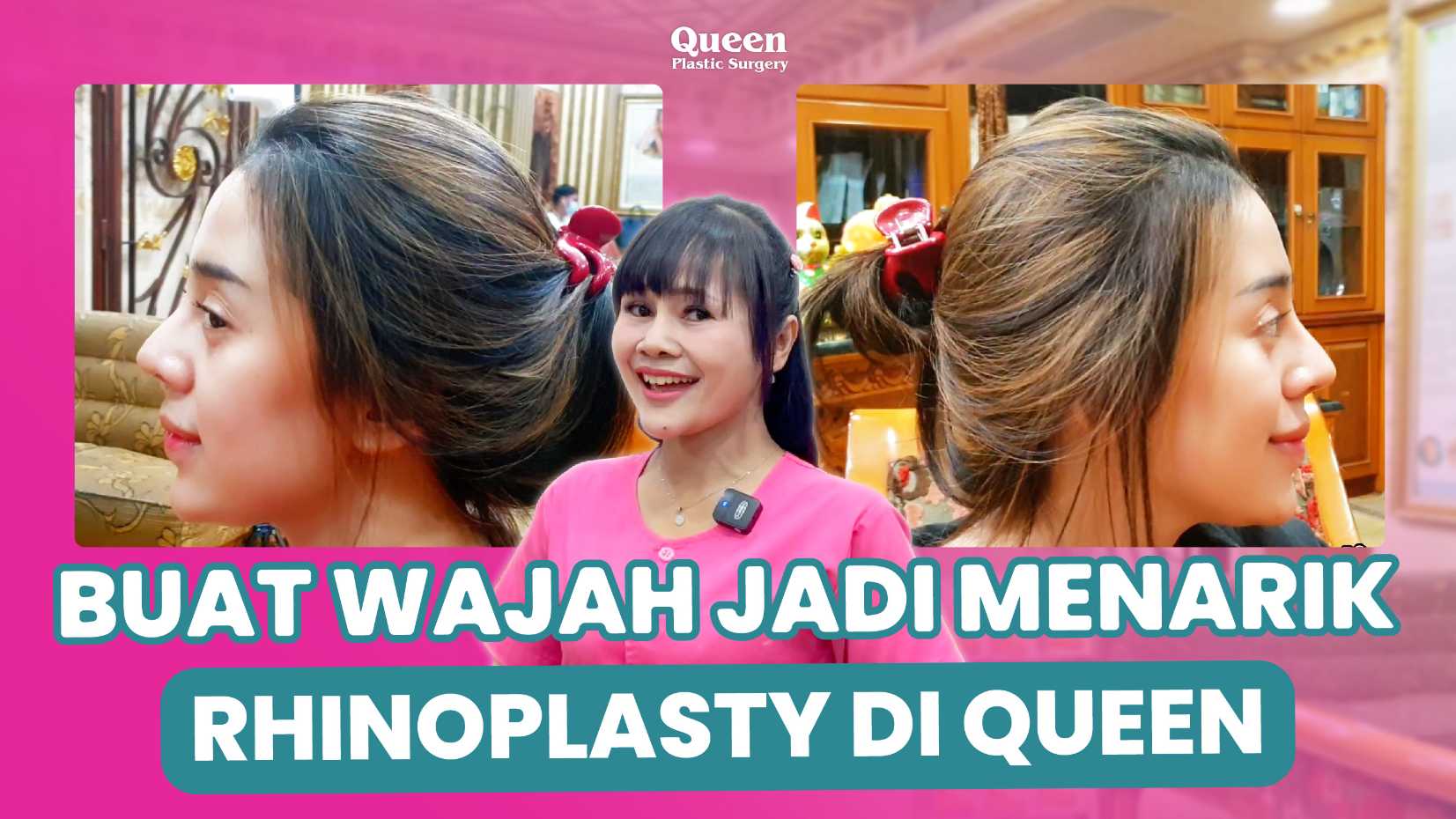 Mata Sayu Kembali Segar dengan Operasi Pengencangan Sub Alis (Sub-Brow Lift)