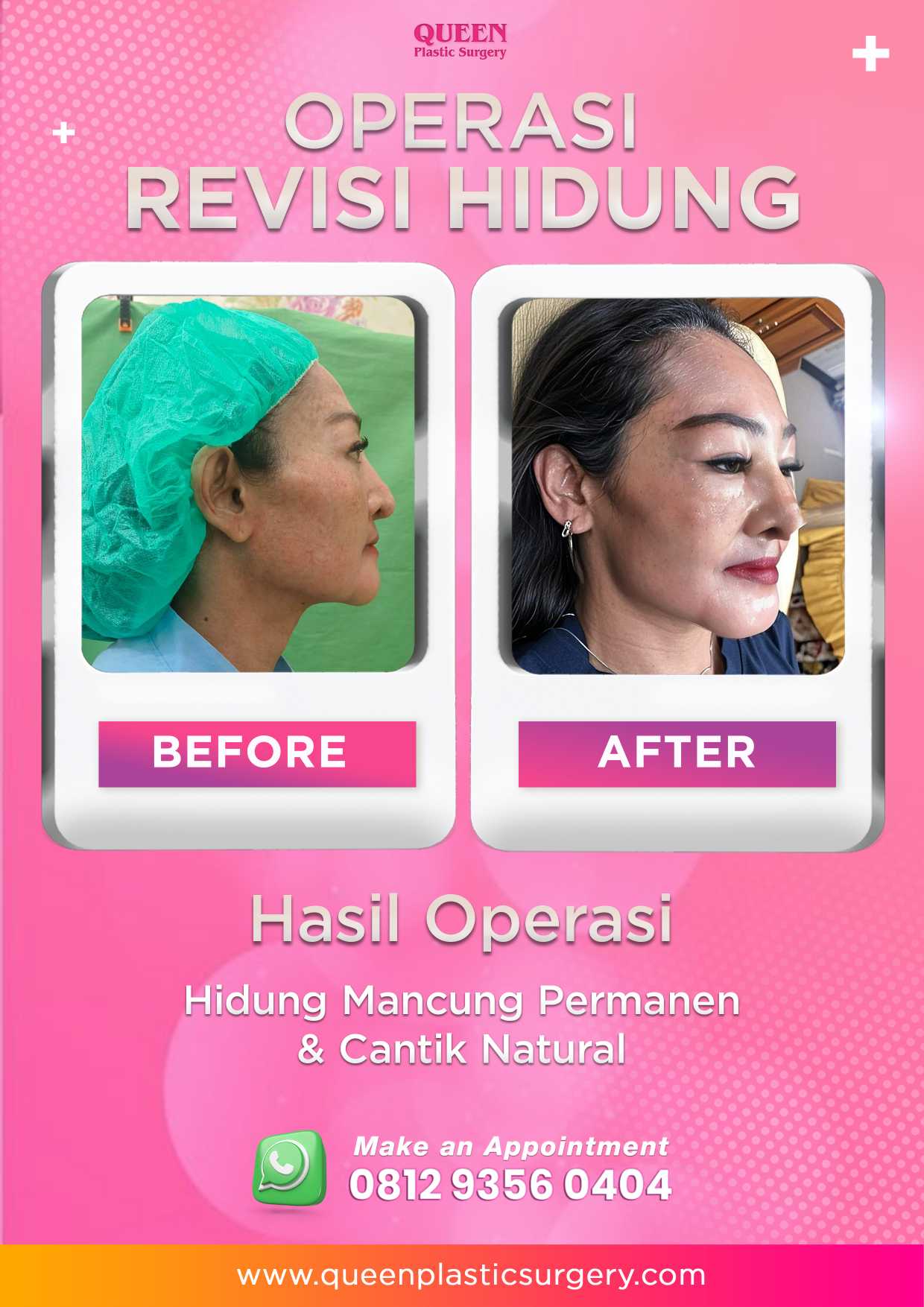 Gagal Operasi Hidung? Ini Tanda Rhinoplasty Tidak Berhasil