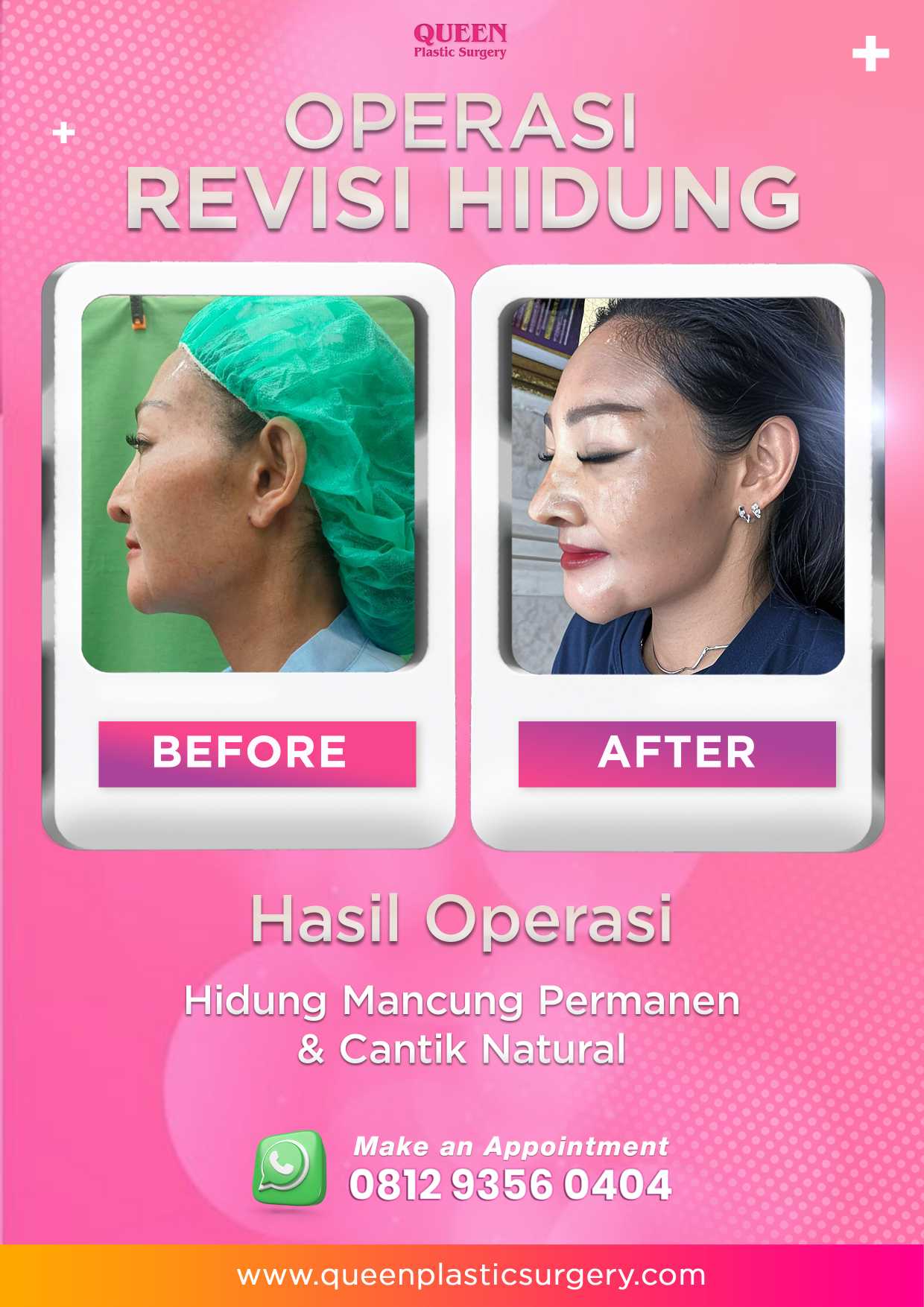 Gagal Operasi Hidung? Ini Tanda Rhinoplasty Tidak Berhasil