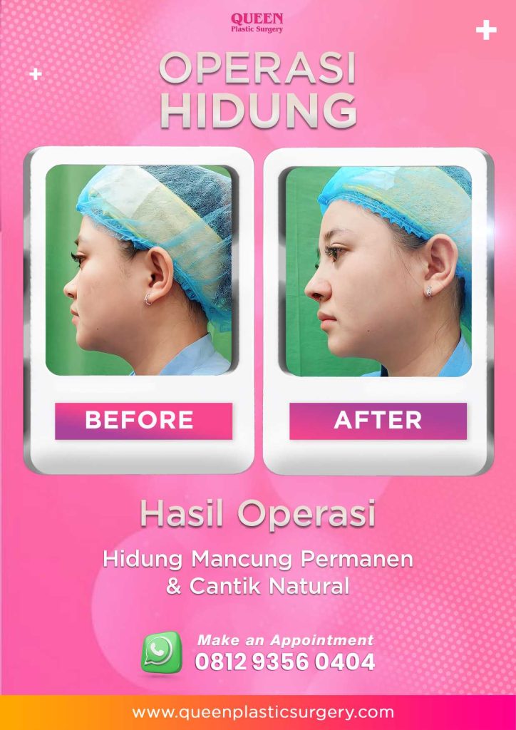 Penting! Memahami Tanda-Tanda Nekrosis Setelah Rhinoplasty Yang Wajib Diketahui