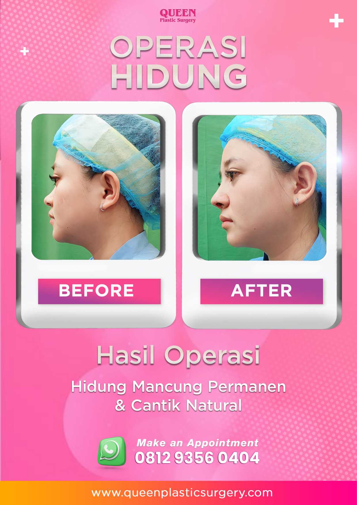 Penting! Memahami Tanda-Tanda Nekrosis Setelah Rhinoplasty Yang Wajib Diketahui