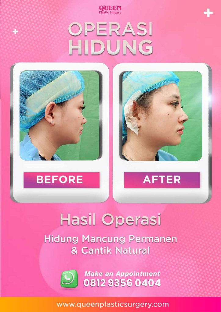 Penting! Memahami Tanda-Tanda Nekrosis Setelah Rhinoplasty Yang Wajib Diketahui