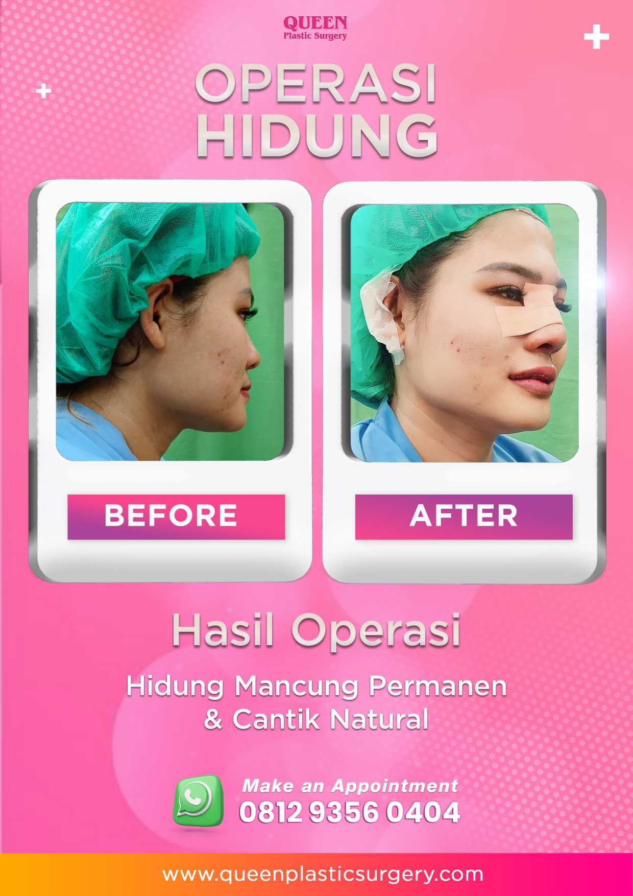 Kapan Hidung Kembali Normal Pasca Rhinoplasty? Yuk, Cari Tahu Prosesnya!