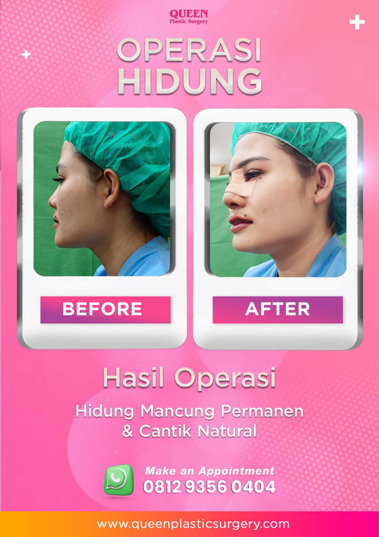 Kapan Hidung Kembali Normal Pasca Rhinoplasty? Yuk, Cari Tahu Prosesnya!