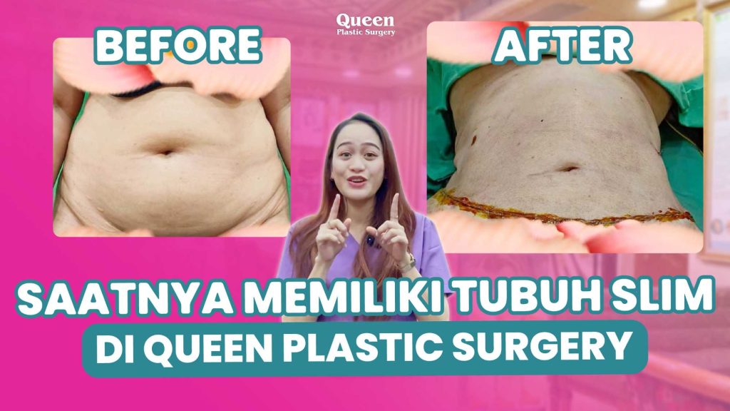 Body Contouring: Sedot Lemak Plus Prosedur Lain yang Ideal, Mulai Perubahan Anda!