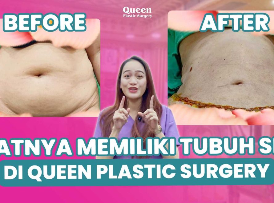 Body Contouring: Sedot Lemak Plus Prosedur Lain yang Ideal, Mulai Perubahan Anda!
