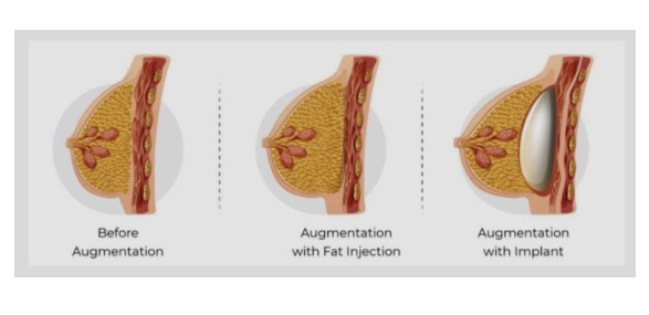 Bisakah Transfer Lemak Menggantikan Implan? Temukan Jawabannya!