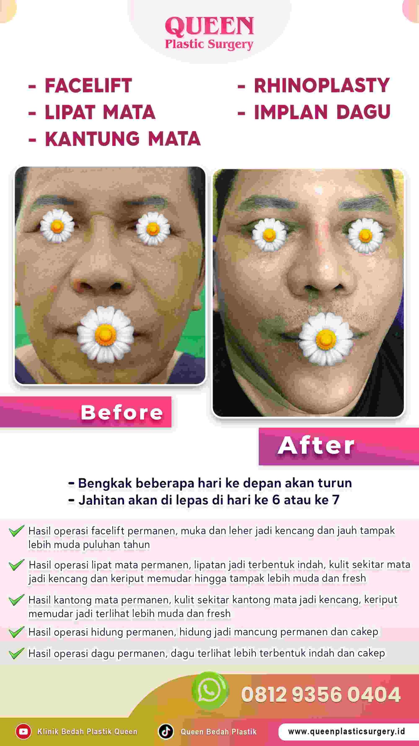 Wajah Tampak Langsing & Awet Muda dengan Facelift