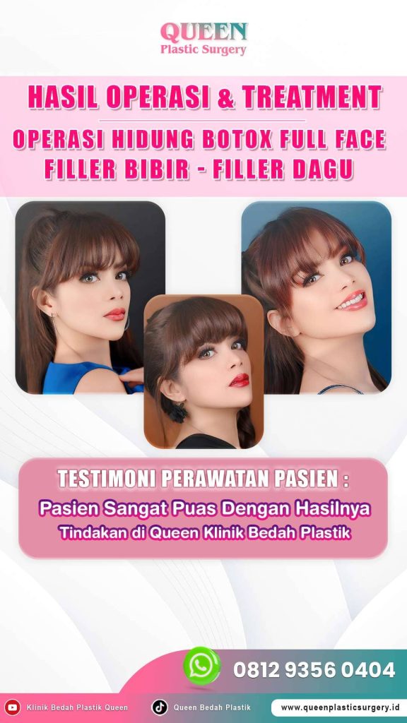 Bukan Sekadar Estetika, Inilah Peran Penting Botox dalam Menangani Bell’s Palsy