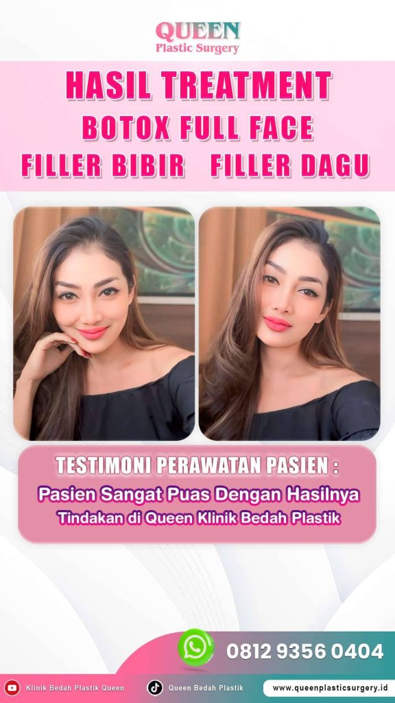 Bukan Sekadar Estetika, Inilah Peran Penting Botox dalam Menangani Bell’s Palsy