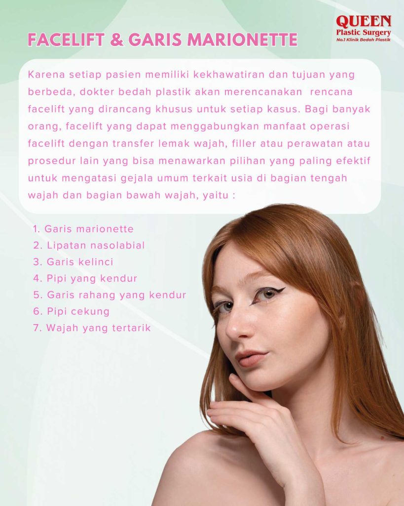 Benarkah Facelift Mampu Mengangkat Sudut Mulut yang Turun (Garis Marionette)?
