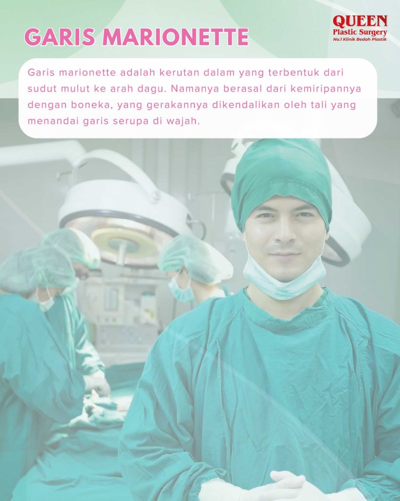 Benarkah Facelift Mampu Mengangkat Sudut Mulut yang Turun (Garis Marionette)?