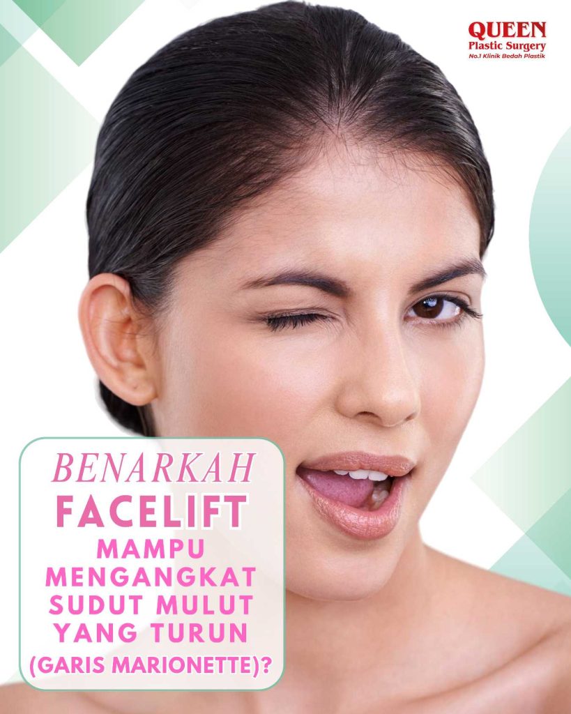 Benarkah Facelift Mampu Mengangkat Sudut Mulut yang Turun (Garis Marionette)?